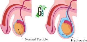 Top 2 Gharelu Upchar For Hydrocele In Hindi (अंडकोश में वृद्धि के दो सफल और अचूक घरेलू उपचार )