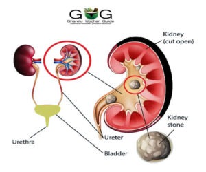 3 Powerful Home Remedies For Kidney Stone (पथरी के तीन चमत्कारी गहरेलू उपचार)